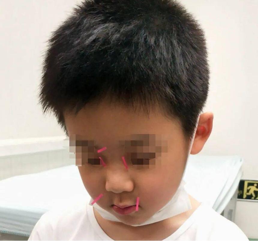 过敏性鼻炎的中医治疗方法有哪些,变应性鼻炎中医疗法