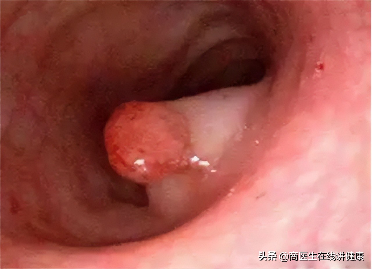 为什么肠道老是长息肉,为什么会有肠道息肉