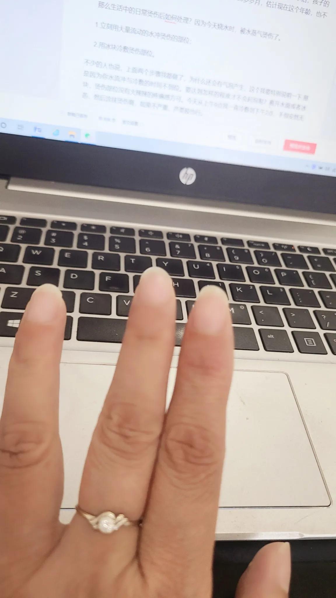 对于烧伤烫伤的正确处理方法,烫伤怎样知道会不会留疤