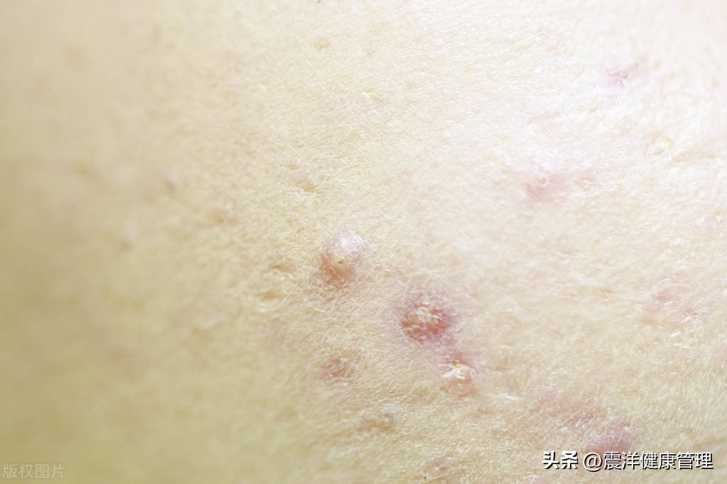 男子腹部痒，医生用镊子夹出16只阴虱！原来阴虱的传播途径有4个