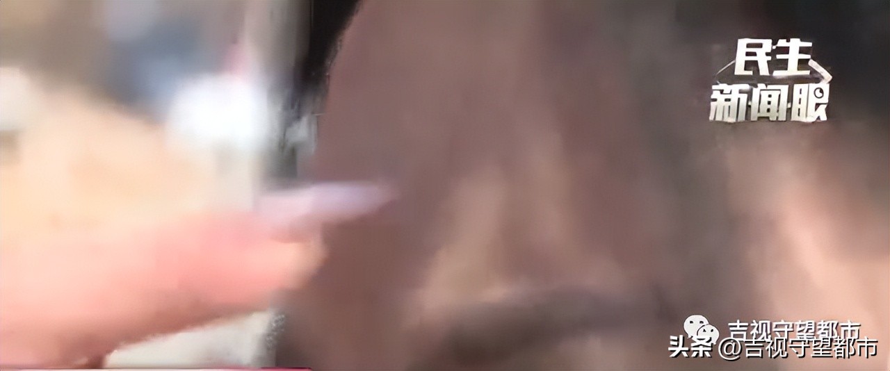 做完填充1年水肿,面部取出填充物手术