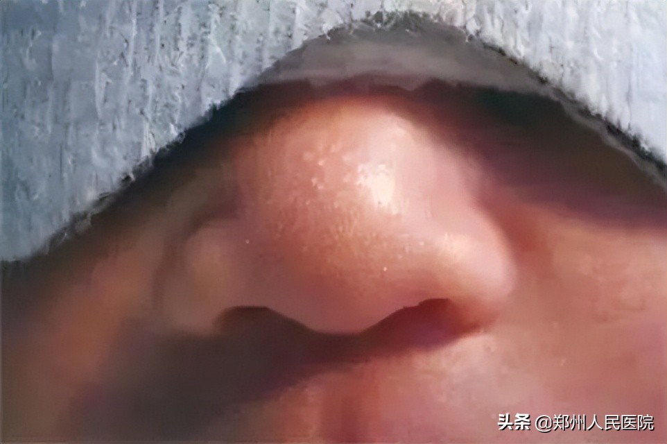 青记、马牙、假月经？别慌！新生儿这些情况都正常