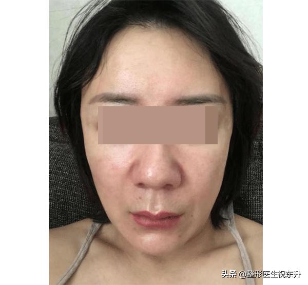 为什么第二次拉皮后法令纹更深了,拉皮手术后多久可以做法令纹填充