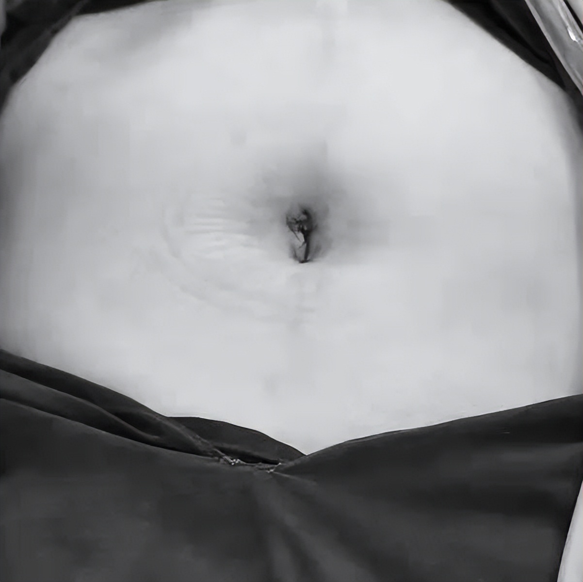 卵巢囊肿微创手术术后没插引流管,腹腔镜下卵巢囊肿切除术的步骤