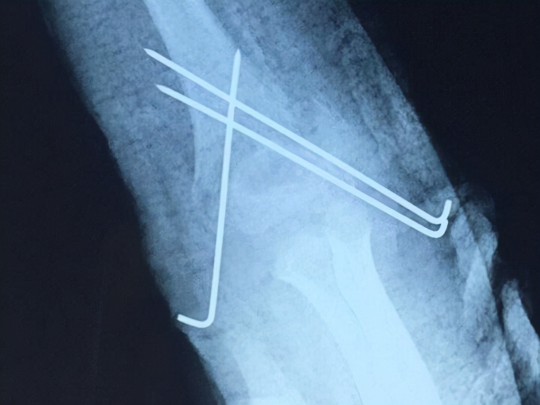肘关节骨折手术需要多少钱,肘关节骨折治疗方法