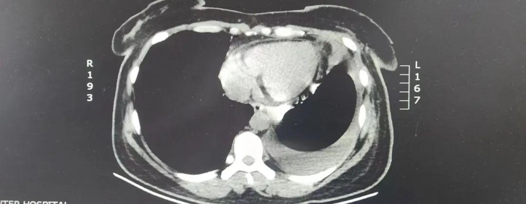 市中心医院胸外科：镜下“小切口”解决纵膈“大问题”