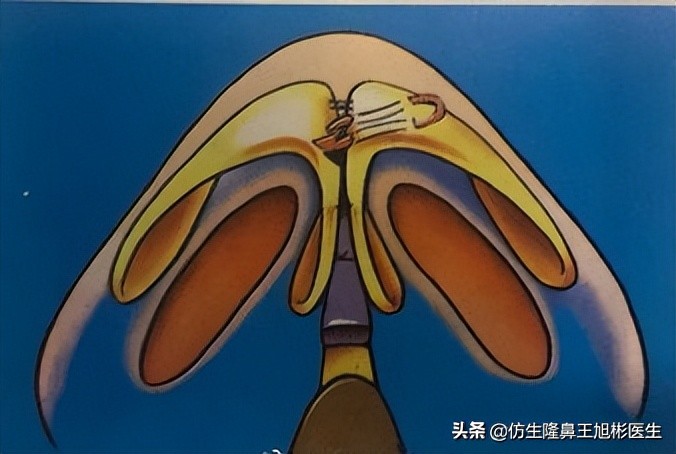 鼻部整形｜鼻头圆钝、扁趴，好看的鼻尖是这么手术来的