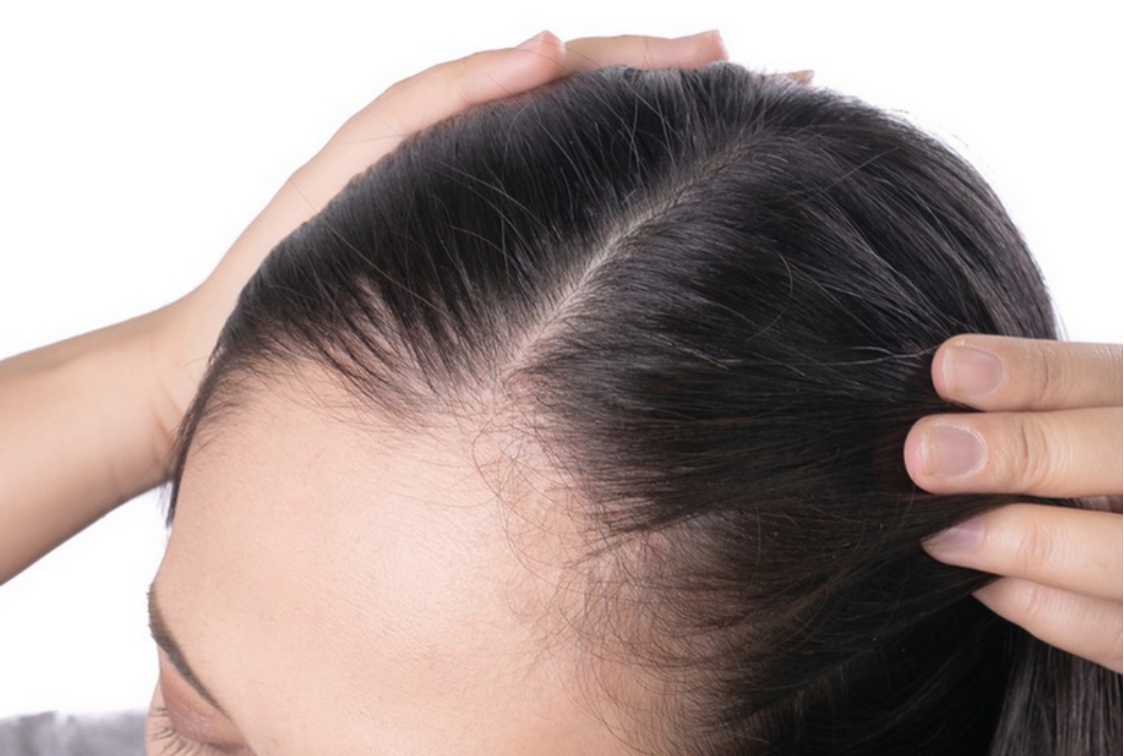 怎么脱发最有效果,怎么样脱发才算严重