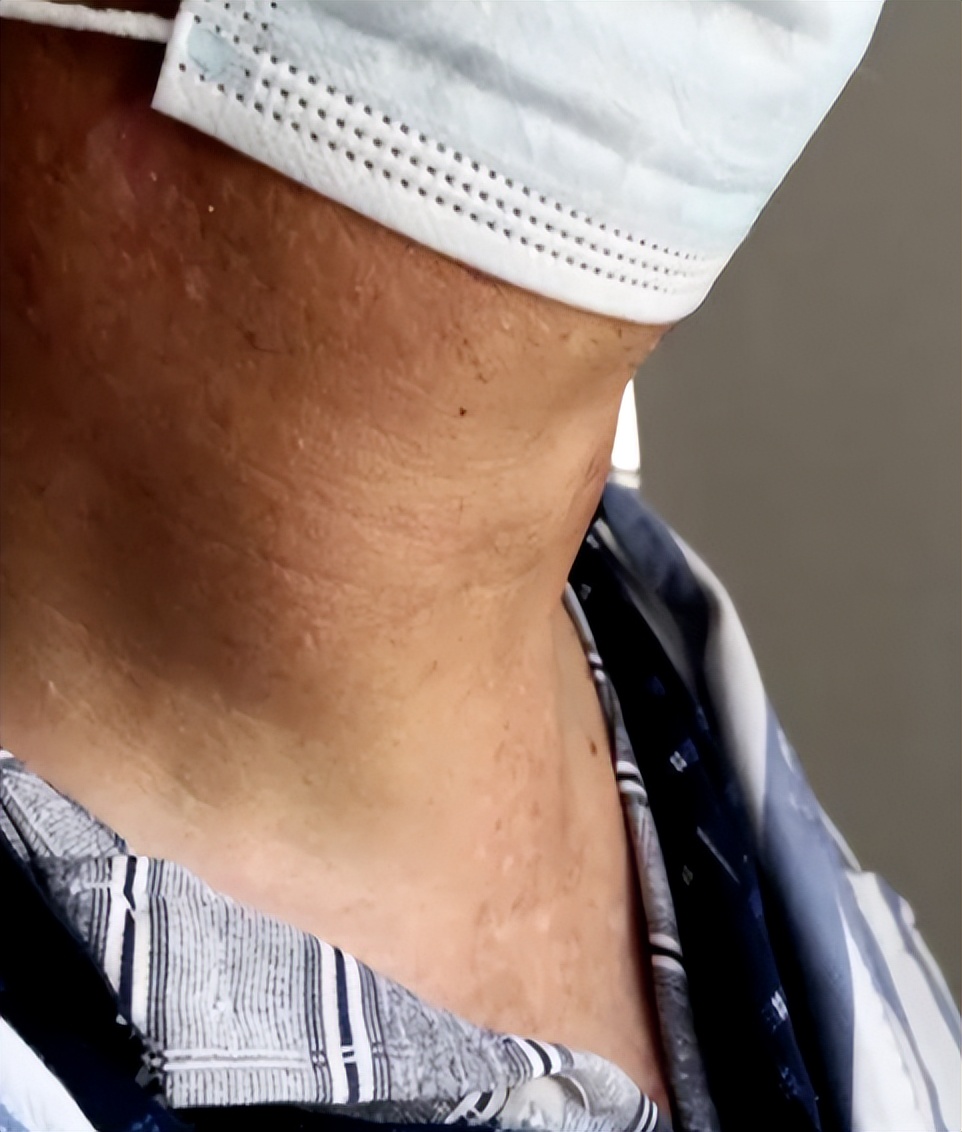 辽宁男子喝3万斤酒撑大脖子,男子嗜酒如命一天三四斤白酒