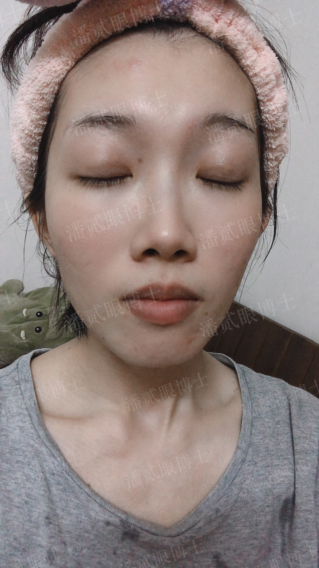 广州姑娘变美后亲述：“我的双眼皮切得很小，只有1厘米多一点”