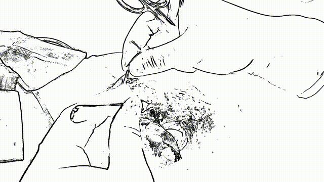 肚皮松弛拉皮手术有副作用吗,脸上做拉皮手术有无副作用