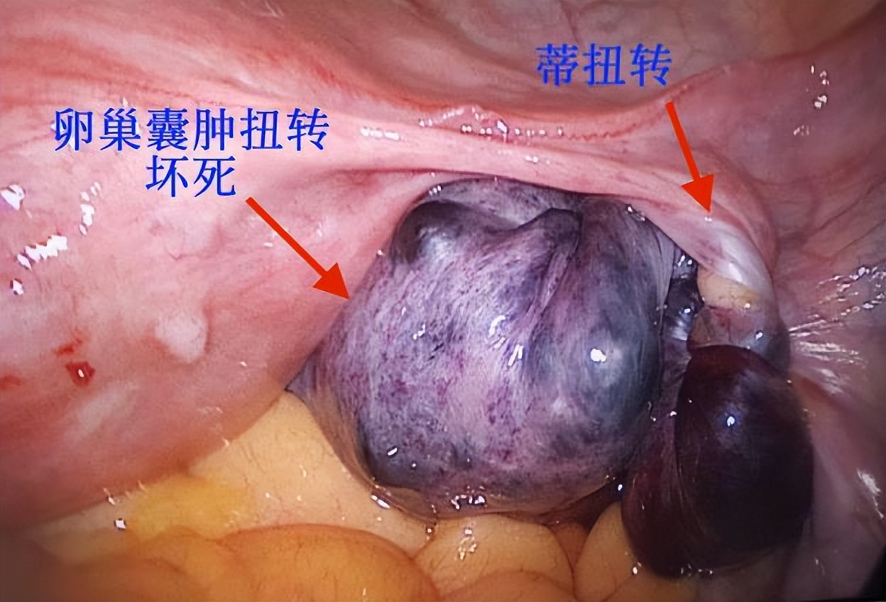 超声显示子宫肌瘤卵巢囊肿,显微镜下的卵巢囊肿