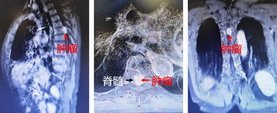 八旬老人瘫痪在床，微创手术重获新生——秦皇岛北医三院神经外科派驻专家为秦皇岛高危患者切除胸椎管肿瘤