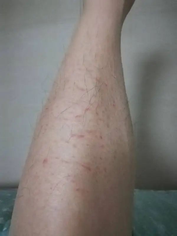 每到秋天，手和腿上就会出现各种干燥情况，还会脱皮，要怎么办？