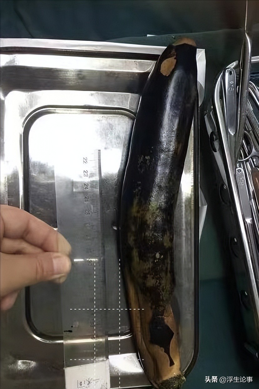 广东60岁男子直肠取出异物,小伙的直肠有25公分的异物
