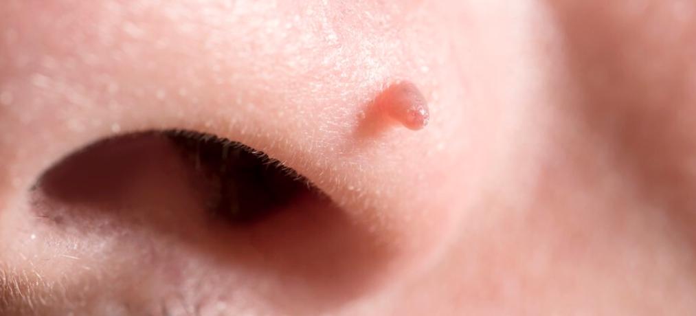 皮肤长的小肉球怎么自己处理,皮肤长出小肉球是什么原因