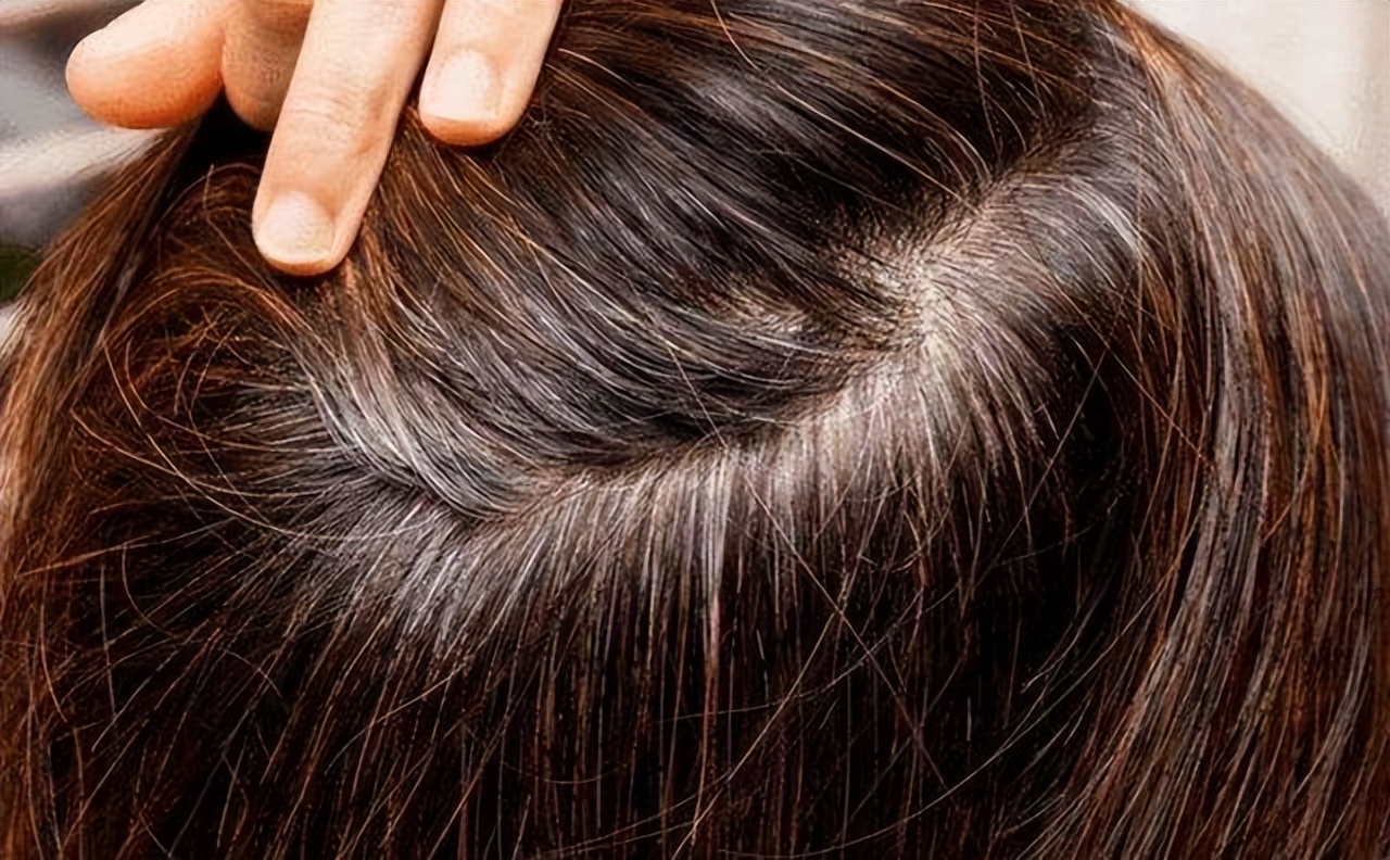 身体缺乏哪种维生素会导致白发,人体缺少什么营养素会造成白发