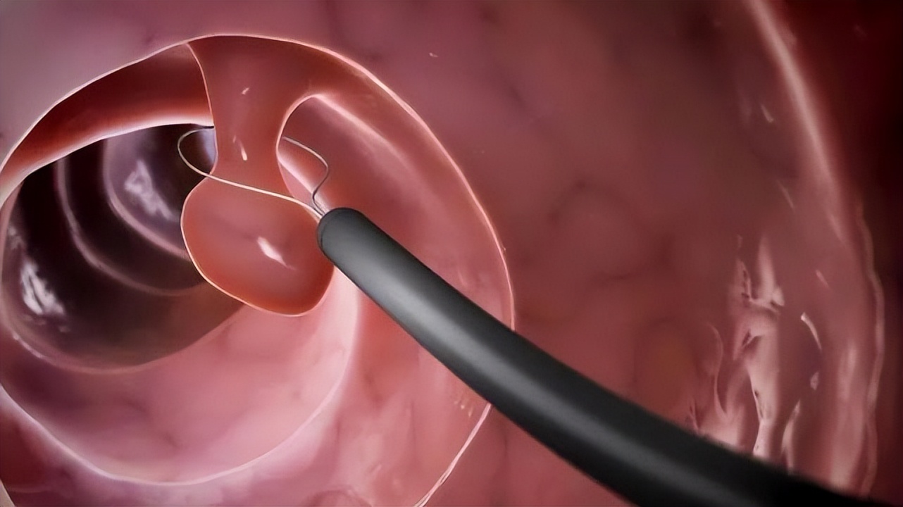 胃肠息肉手术后多久可以洗澡,做肠息肉和胃息肉多长时间能洗澡