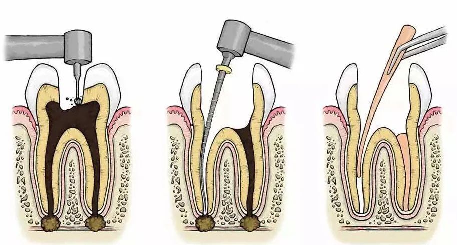 杀死牙神经牙能维持多久,杀死牙神经后多久可以吃饭