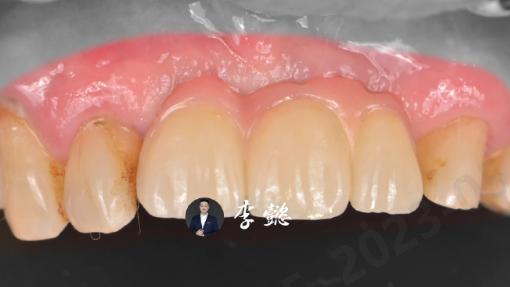 种植牙之前你一定要搞清楚这7件事？