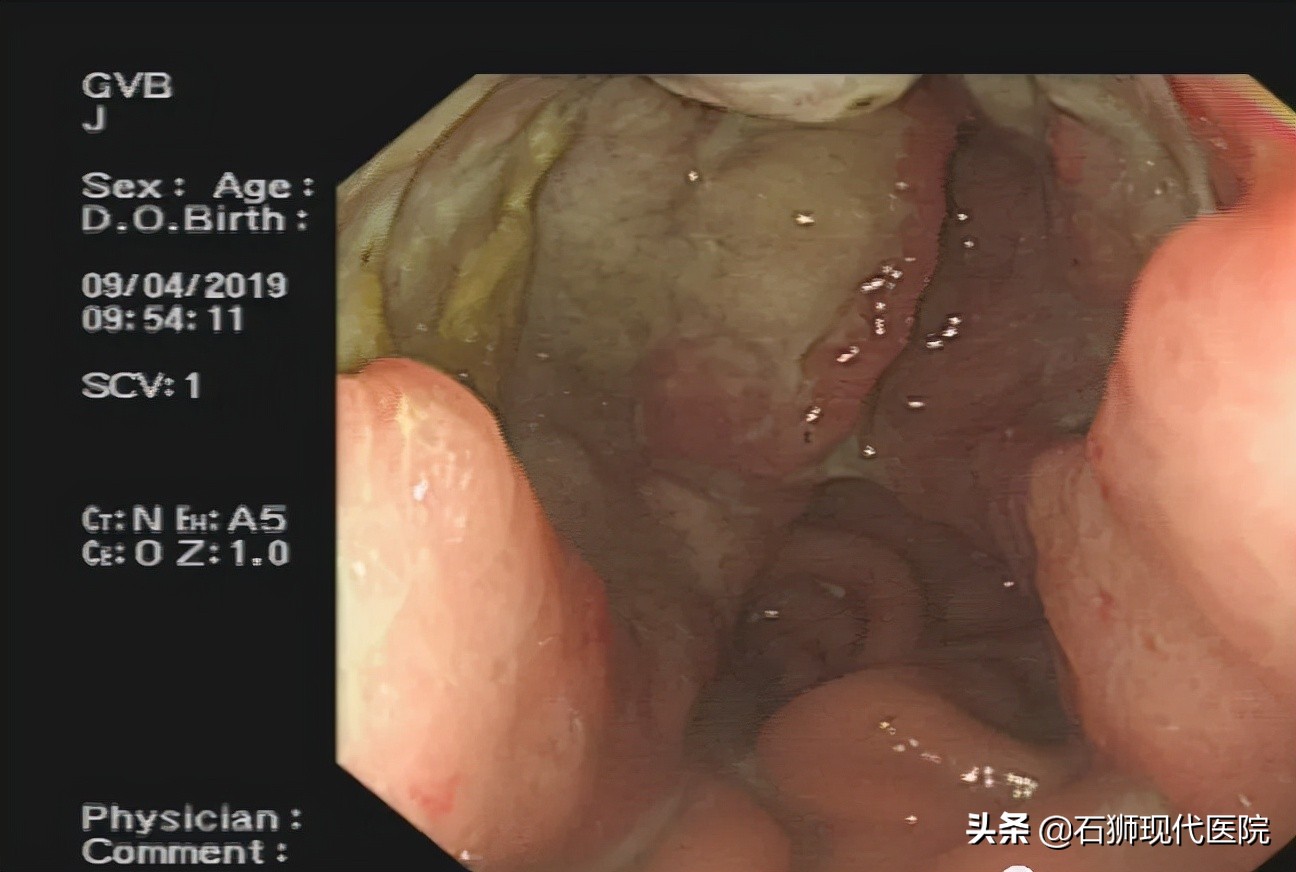 石狮医院有无痛胃镜吗,有哪些人不合适做胃镜