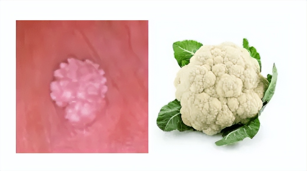 女生得了一颗尖锐性湿疣,女性肛周长湿疣什么原因