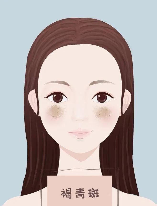 30岁脸上长斑怎么办需要注意什么,产后脸上有斑怎么办需要注意什么