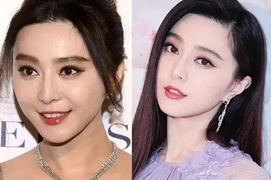 烤瓷牙一定要做桩吗,烤瓷牙用哪种牙套好