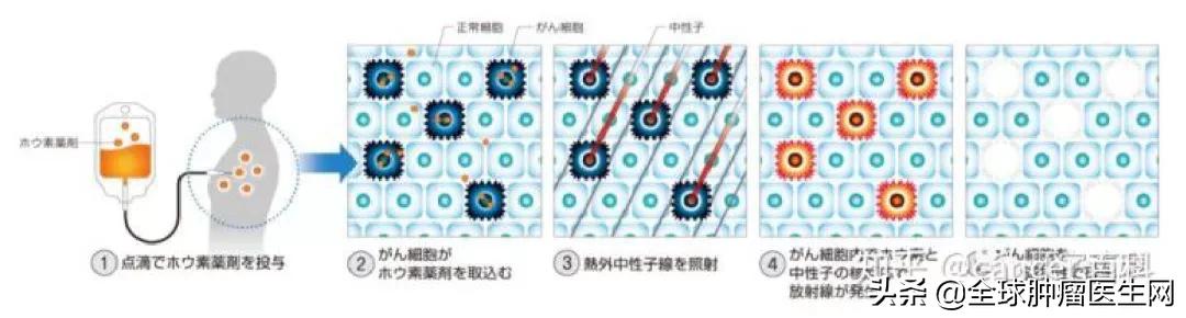 日本硼中子俘获疗法治愈癌症晚期,日本硼中子治疗癌症最新进展