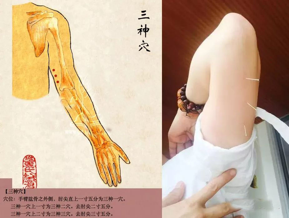 泌尿系疾病针灸,泌尿系统感染针灸哪里最有效