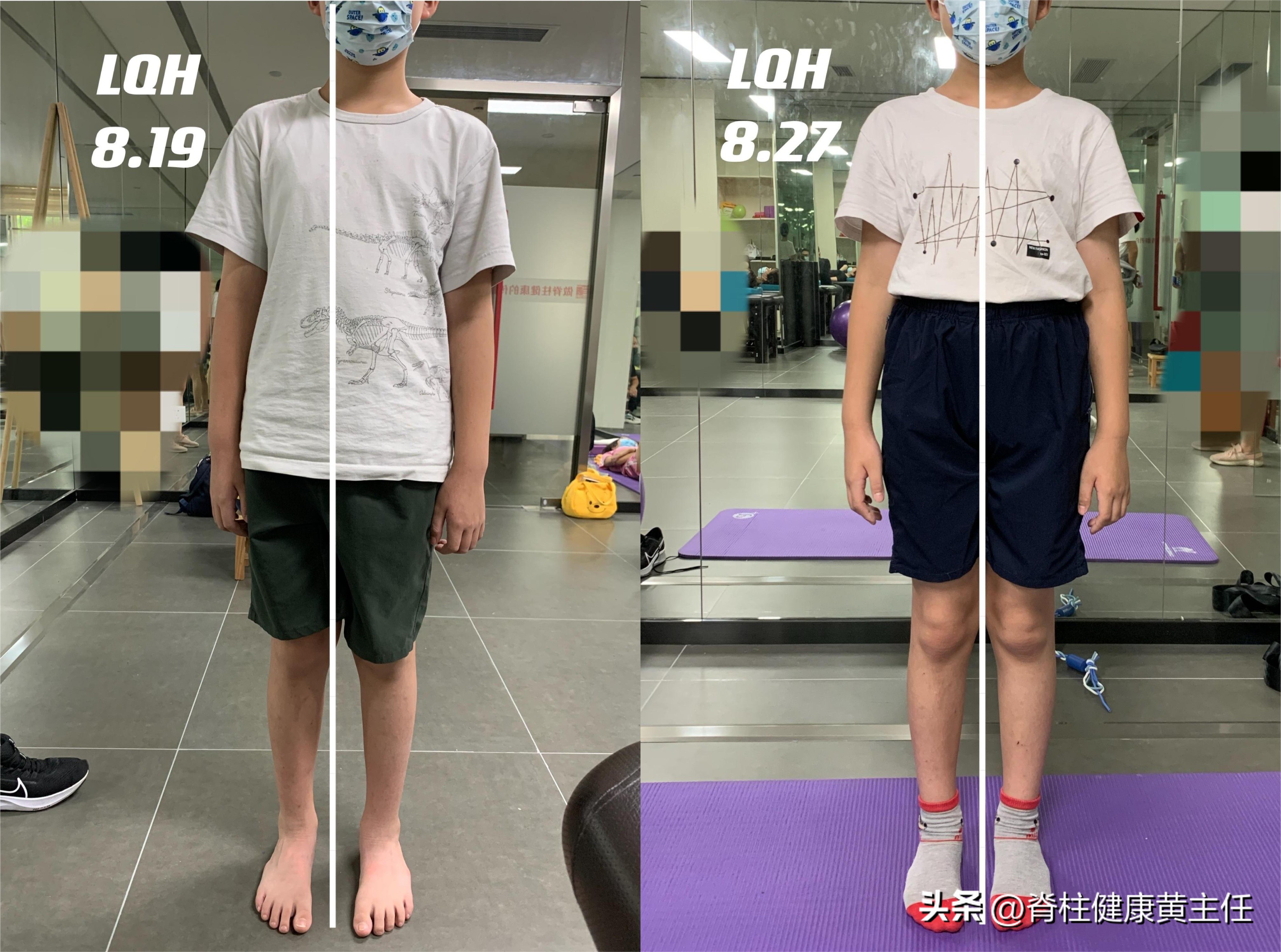 扁平足o型腿骨盆前倾高低肩,一只脚是扁平足怎么矫正