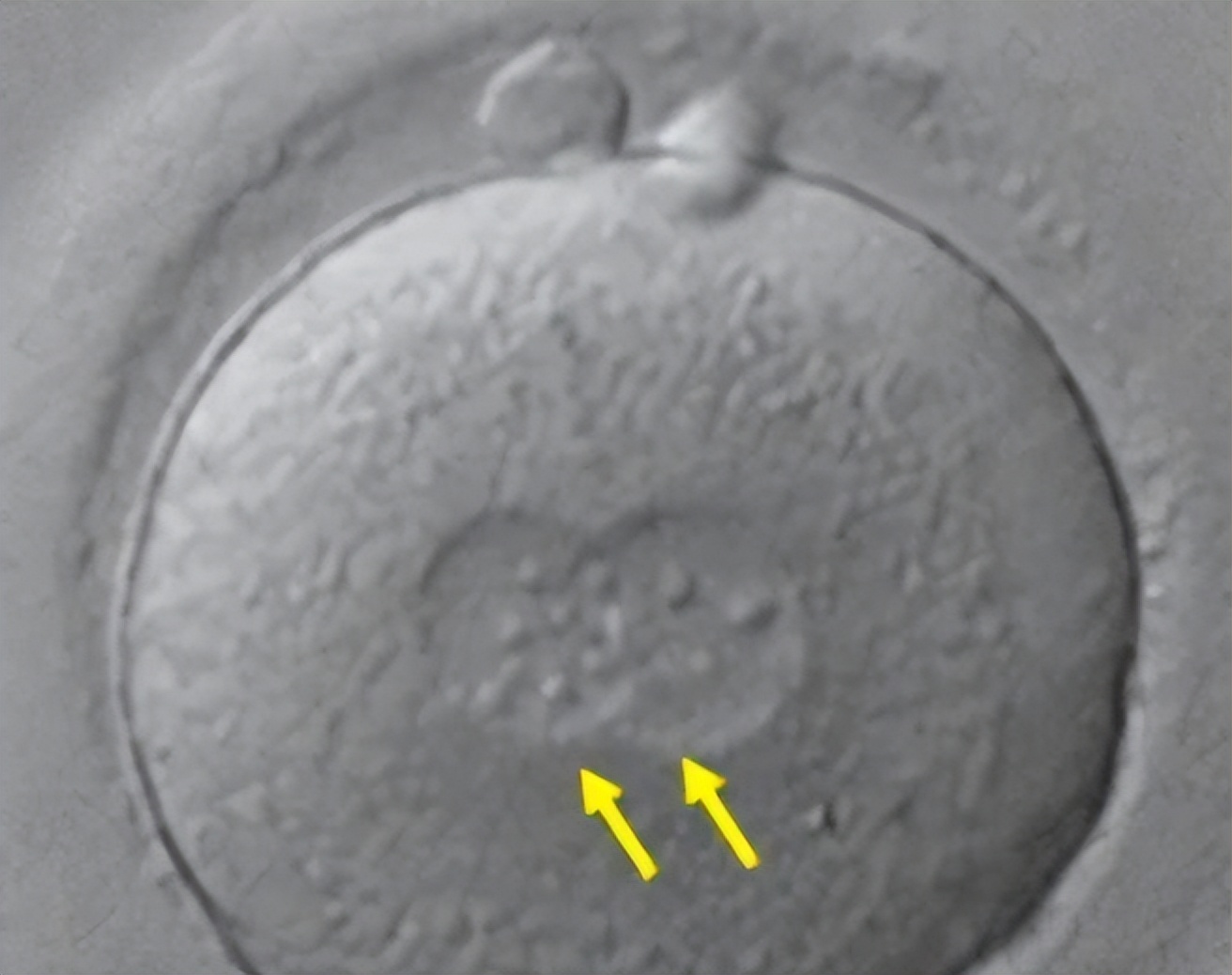 胎记的图案表明一种新的黑素细胞前体在原肠胚形成前后出现