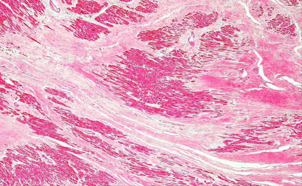 透明质酸钠修复凝胶医用,医用透明质酸钠凝胶防增生吗