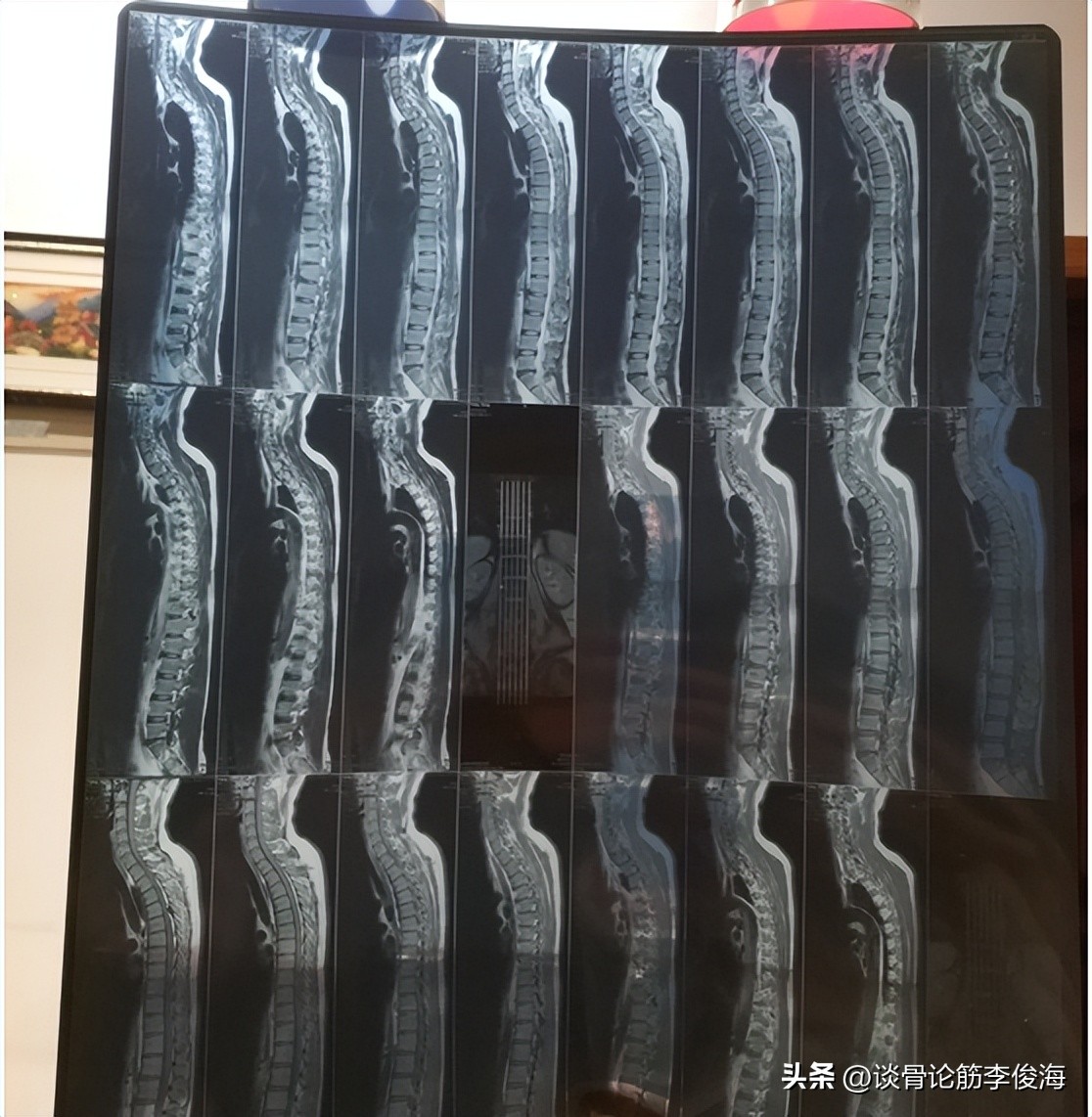 关于椎间盘突出的康复治疗,椎间盘突出治疗指南