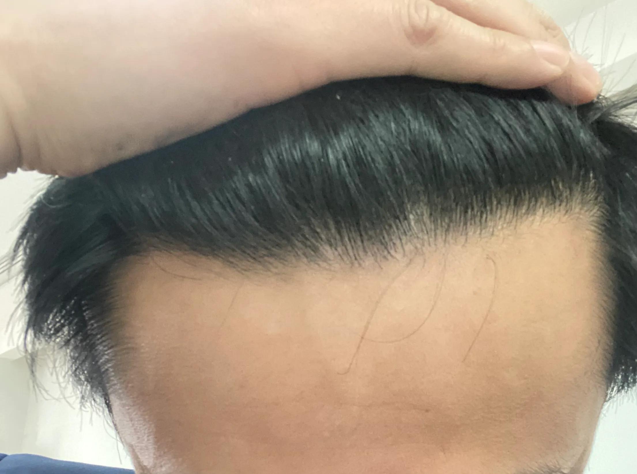 4万元植发一年后效果不明显,男生大面积植发八个月真实效果