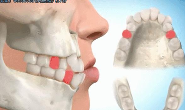 凸嘴形成的原因及凸嘴矫正方法,凸嘴如何改善