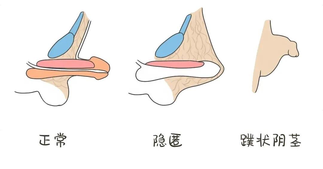 男孩JJ多大才算达标？“丁丁”尺寸国际标准来了！男宝家长请注意