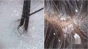 头皮屑特别多怎么去除最简单方法,头皮屑太多在家里怎么处理