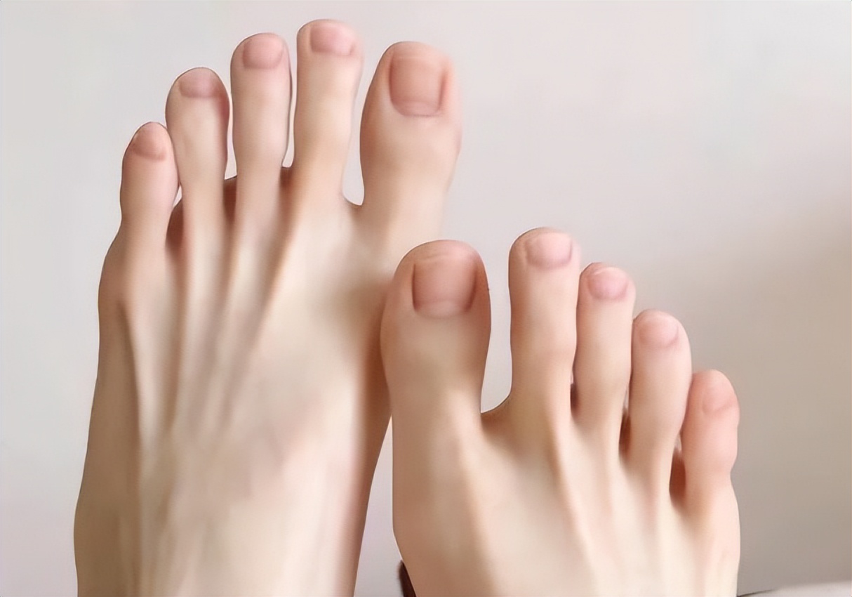 5年灰指甲治愈最简单方法,三年的灰指甲会好吗