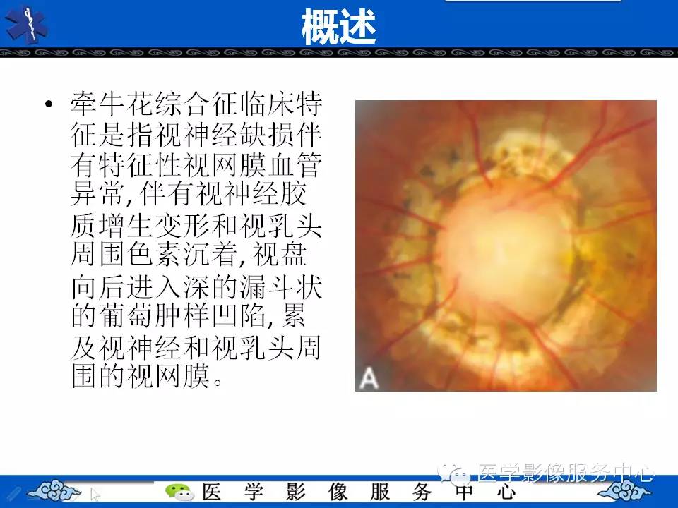 牵牛花综合征可能误诊吗,牵牛花综合征视角