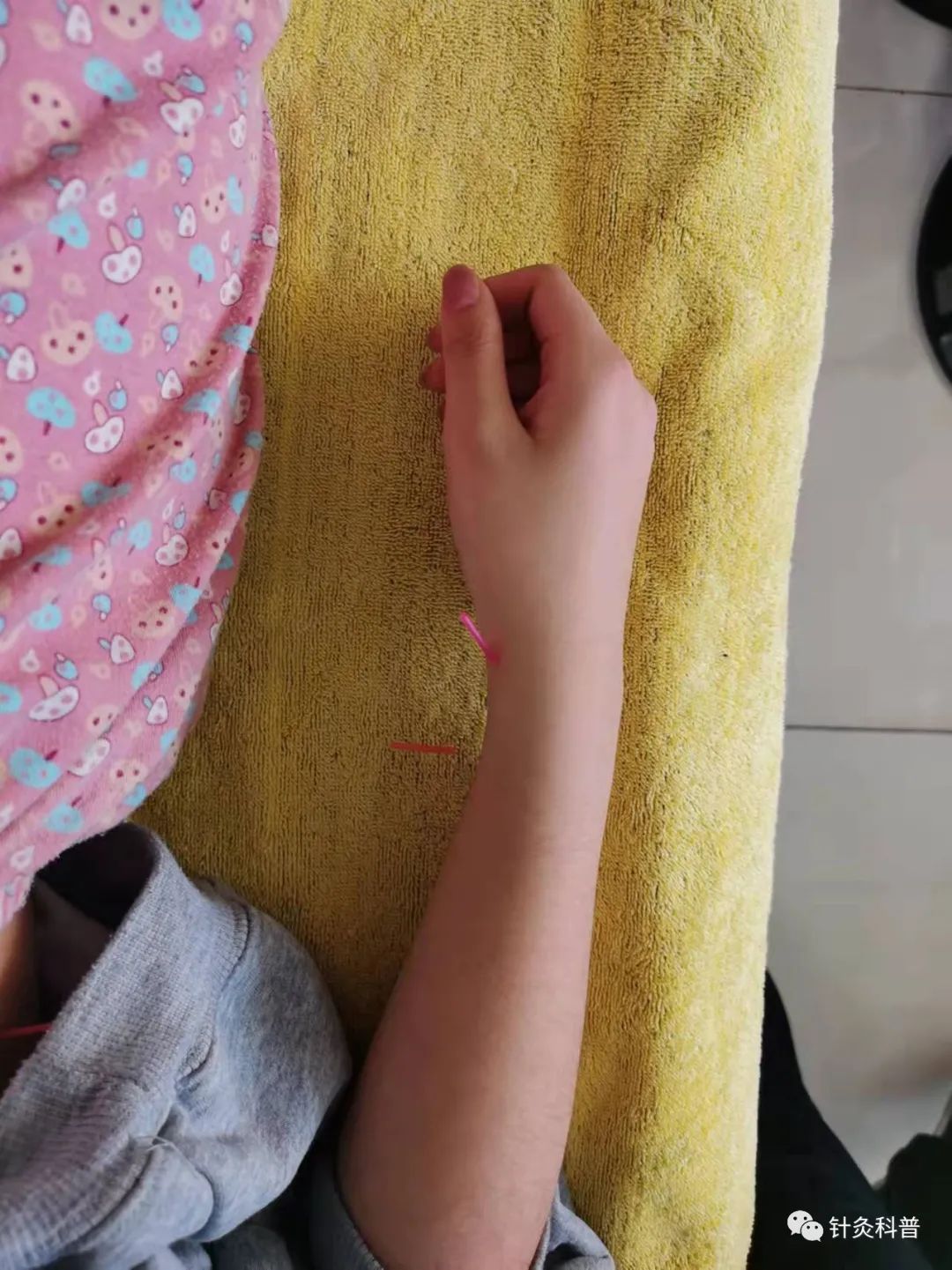 针灸治病治愈案例,针灸治疗妇科杂病视频