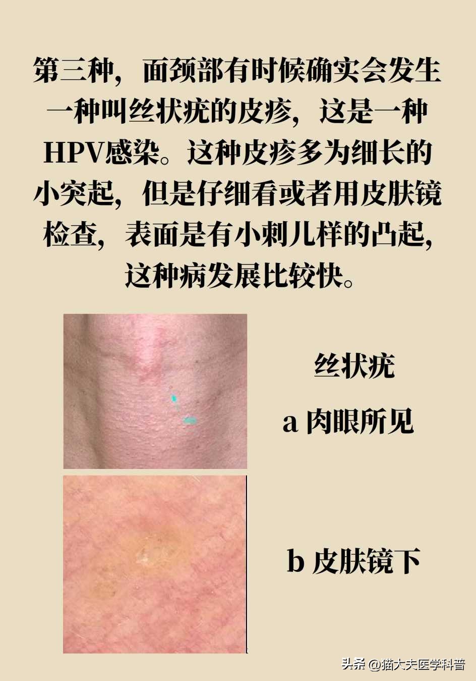 脖子上长的小肉揪怎么治啊,疣丝是不是脖子上的小肉粒