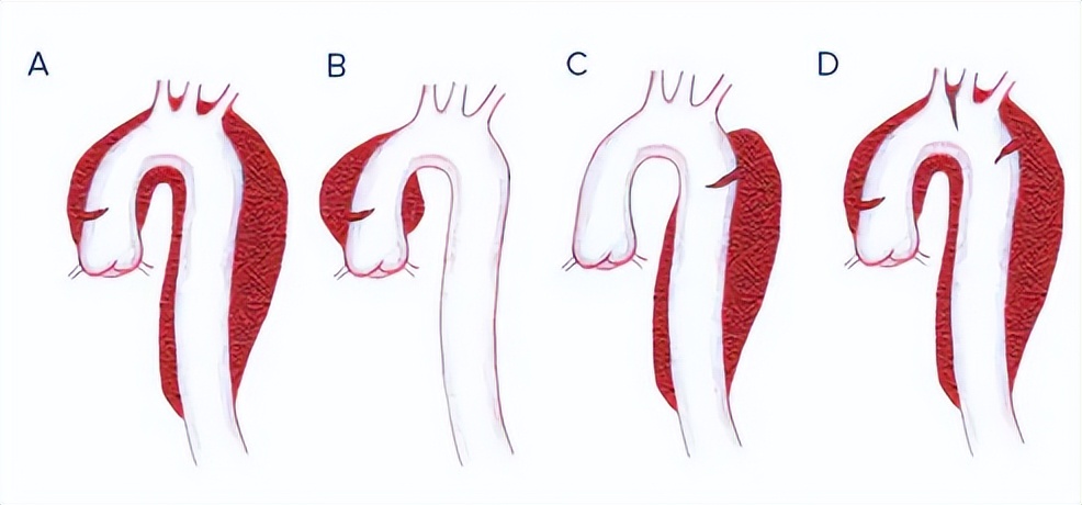 主动脉夹层心率太快,主动脉夹层的凶险