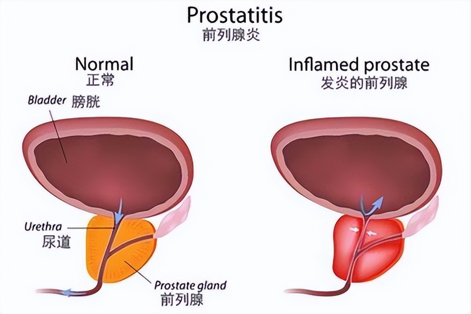 保护前列腺的4个方法，做好这些事能够有效预防前列腺疾病