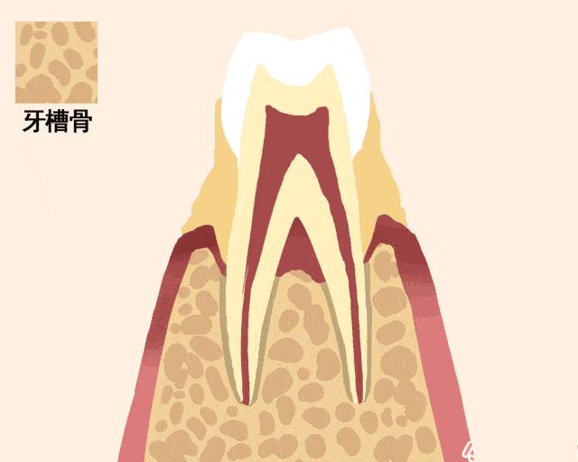 牙垢清除的几个小窍门牙周炎,牙齿那些事儿vlog