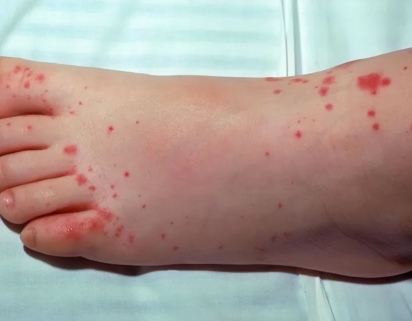 吻痕是不是出轨的证据,老公身上有吻痕可作为出轨证据吗