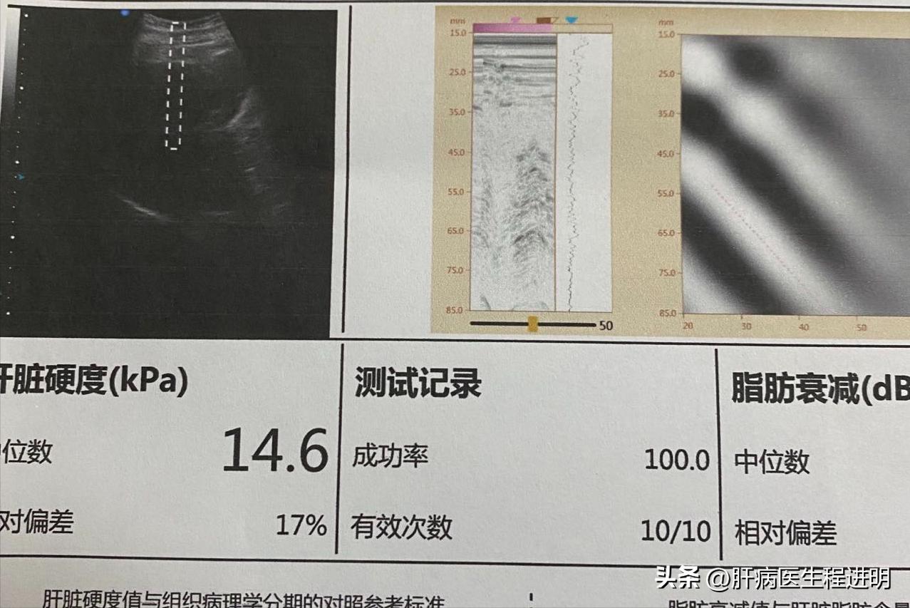 肝脏0.6厘米稍强回声结节怎么治疗,乙肝患者肝脏有结节是怎么回事