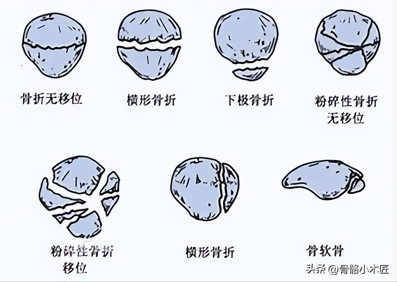髌骨骨折二次手术取钢丝痛苦吗,髌骨骨折取钢钉手术完多久能走