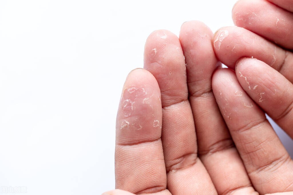 湿疹的人可以养猫吗,湿疹患者可以养鸟吗