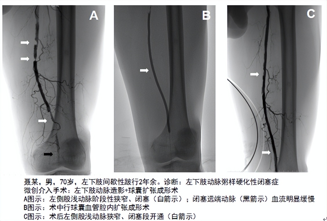 小腿发凉脚疼足疗能治好吗,手脚麻木走路腿疼特效药